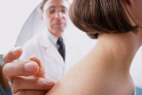 Managing Fibromyalgia: Acupuncture acupuncture on woman