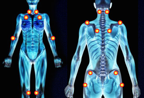 Fibromyalgia Tender Points skeletal images